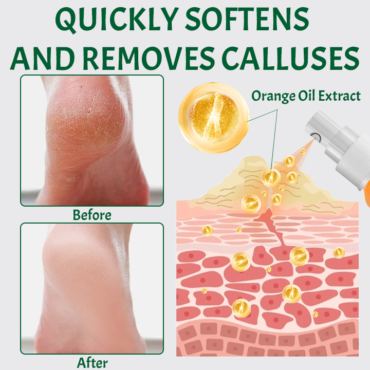 SmoothFeet Callus Remover Spray (BUY 1 GET 1 FREE + COD)