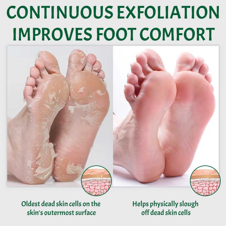 SmoothFeet Callus Remover Spray (BUY 1 GET 1 FREE + COD)
