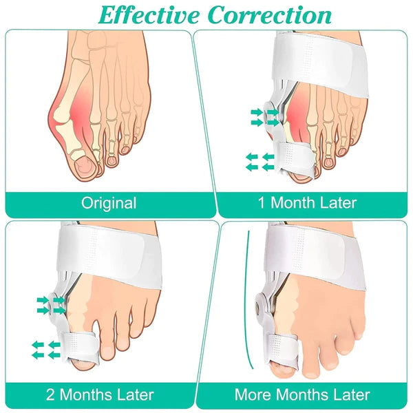 Bunion Toe Shaper - BUY 1 GET 1 FREE