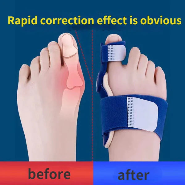 Bunion Toe Shaper - BUY 1 GET 1 FREE