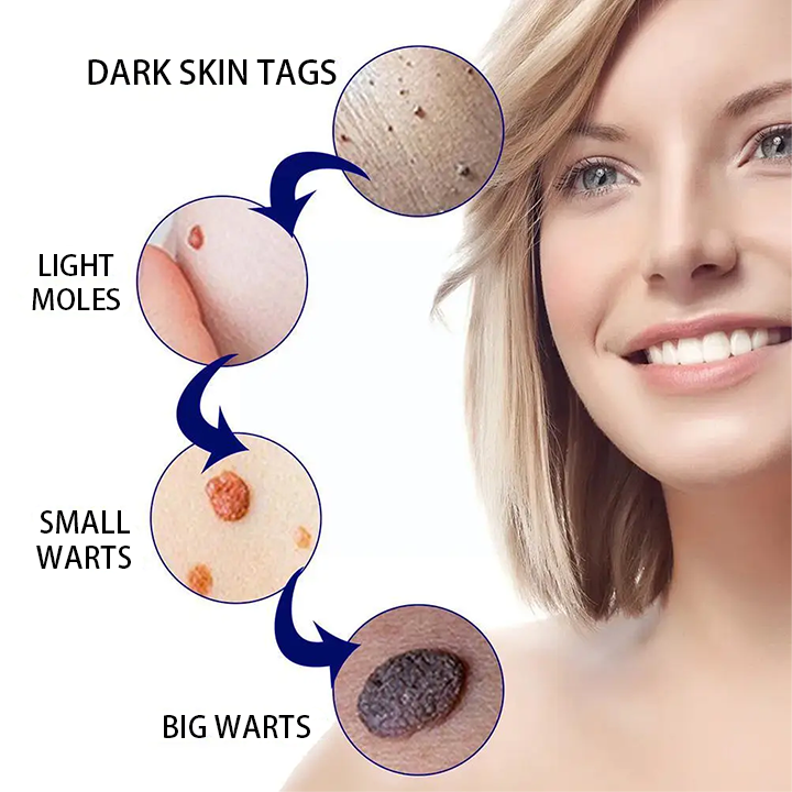 Anti-wart Skin Smoothing Spider Serum (BUY 1 GET 1 FREE + COD Available)