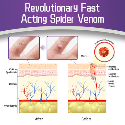Anti-wart Skin Smoothing Spider Serum (BUY 1 GET 1 FREE + COD Available)